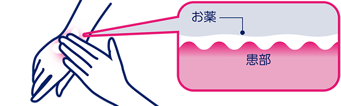官方塗藥示意：將藥輕輕覆蓋患部，不用力揉搓